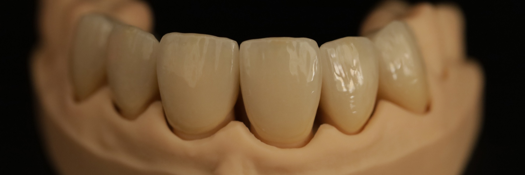 Ceramic dental crowns on models