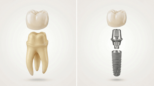 3D illustration comparing a dental crown over tooth vs implant with abutment and screw