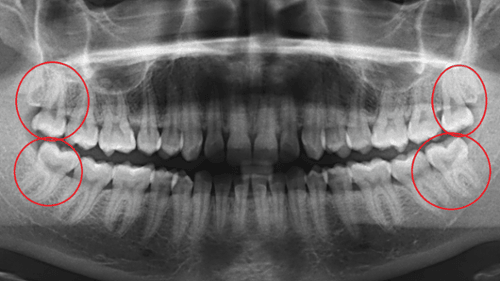OPG Xray with red circles around wisdom teeth