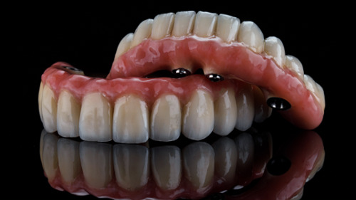 full arch implant prosthetic restorations