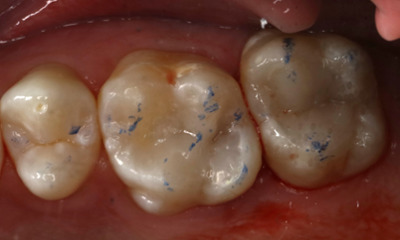 Restored molars after restoration