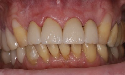 Four-upper-incisor-ceramic-crowns-repairing-stained-and-decayed-teeth-After-Image