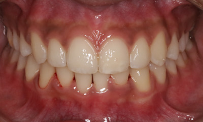 intraoral photograph after orthodontic treatment