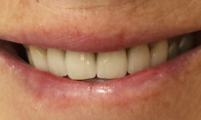 Upper-canine-to-canine-zirconia-ceramic-crowns-After-Image