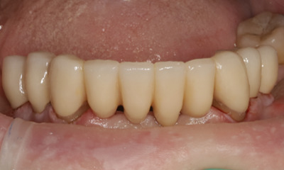 lower canine to canine bridge and individual crowns on premolars