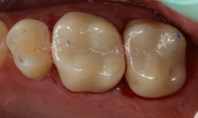 Upper molar case photo showing high strength zirconia crowns restoring the first and second molars