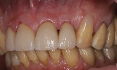 Side angle after ceramic crowns photo