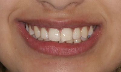 photograph smiling after orthodontic treatment