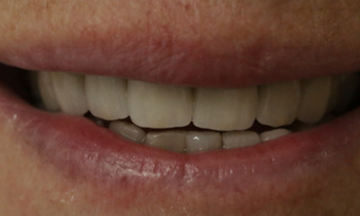 front angle patient photo after canine to canine ceramic dental crown made from porcelain fused to zirconia crowns