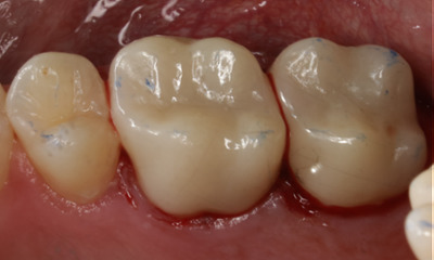 Steep angle photo after zirconia ceramic crowns placed