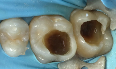 Decayed molars before restoration.