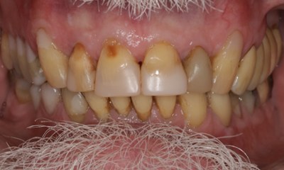 Four-upper-incisor-ceramic-crowns-repairing-stained-and-decayed-teeth-Before-Image