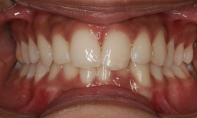 Intraoral photograph before orthodontic treatment with crowding