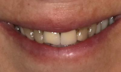 Upper-canine-to-canine-zirconia-ceramic-crowns-Before-Image
