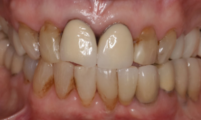 Patient photo IO frontal shot before upper canine to canine ceramic dental crowns replacing decay discolored chipped old metal crowns